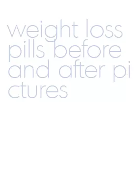 weight loss pills before and after pictures