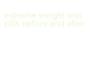 extreme weight loss pills before and after