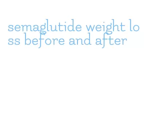 semaglutide weight loss before and after